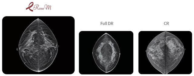 Як зробити цифровий апгрейд мамографічного апарату? Перетворіть свій аналоговий мамограф на цифрову систему.  