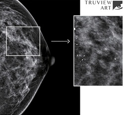 Як зробити цифровий апгрейд мамографічного апарату? Перетворіть свій аналоговий мамограф на цифрову систему.  