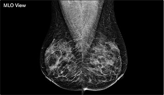 Як зробити цифровий апгрейд мамографічного апарату? Перетворіть свій аналоговий мамограф на цифрову систему. 